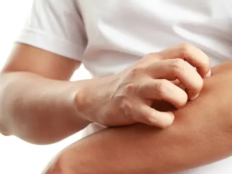 Uczulenie na nikiel — przyczyny, objawy leczenie